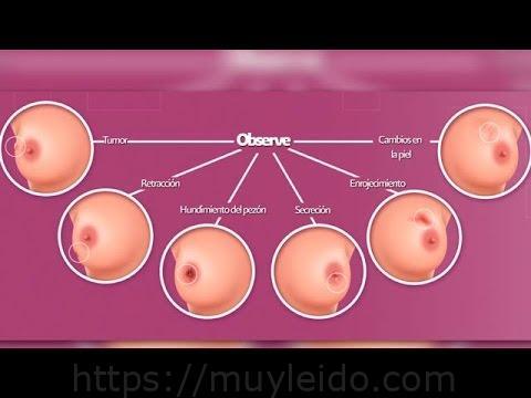 Descubre cómo son los bultos de cáncer de mama y su detección