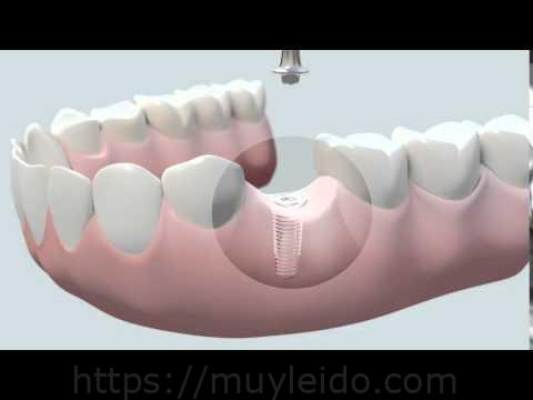 Implante dental: aprende cómo se coloca paso a paso